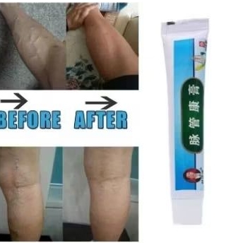 krim penghilang varises original