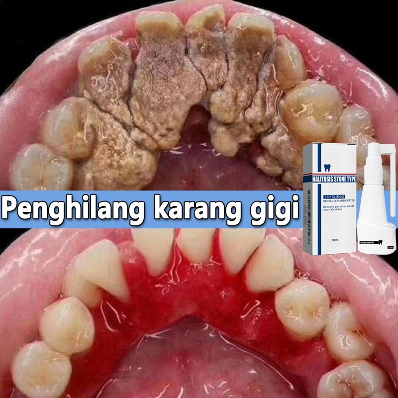 perontok karang gigi paling ampuh pembersih gigi kuning dan karang alat pembersih karang gigi penghi