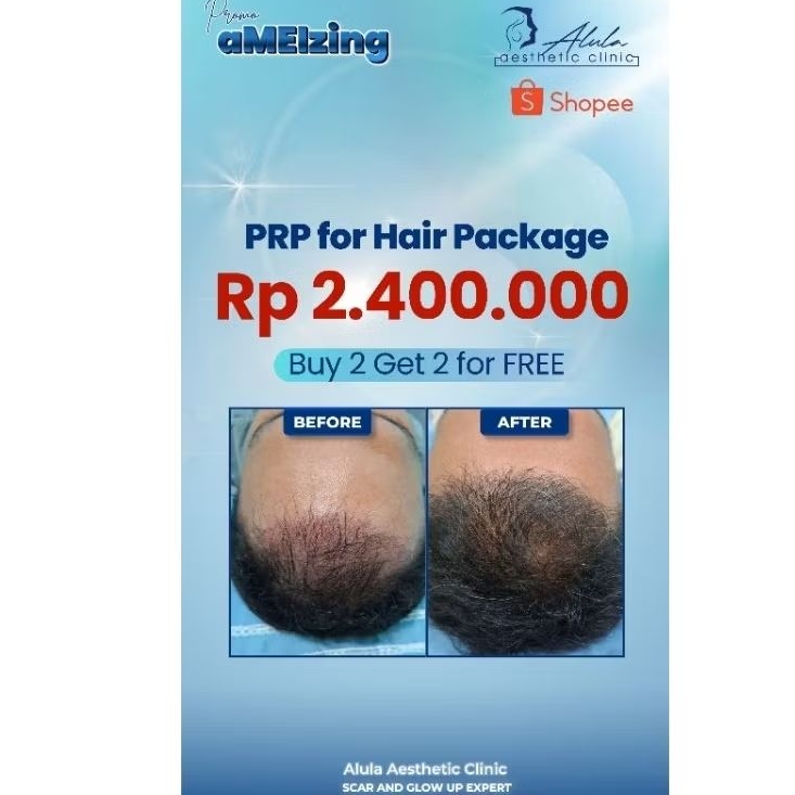 Voucher Treatment PRP for Hair