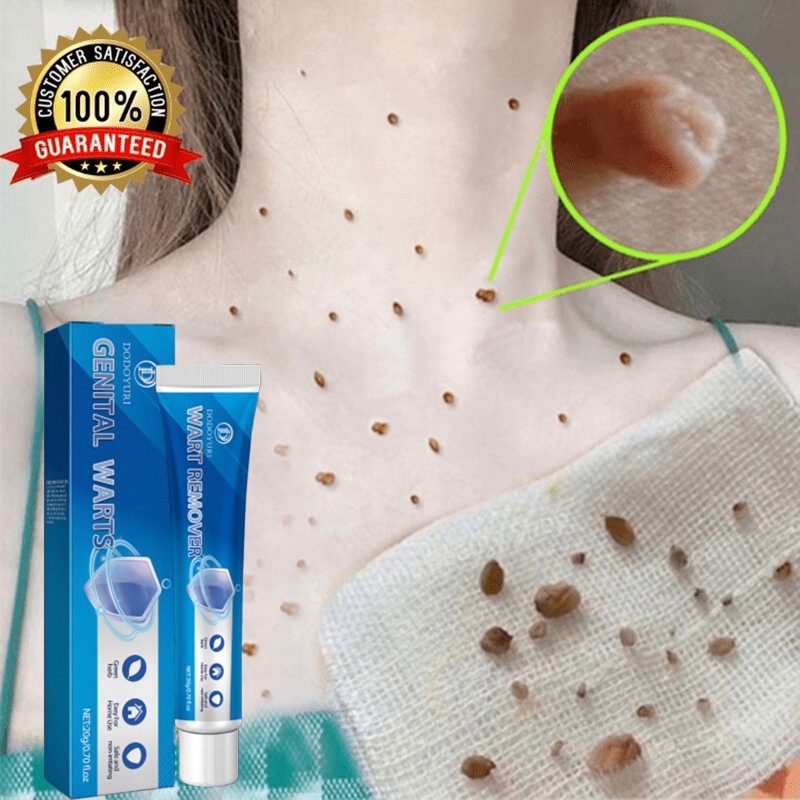 Obat kutil penghilang kutil salep kutil paling ampuh skin tag remover 20g