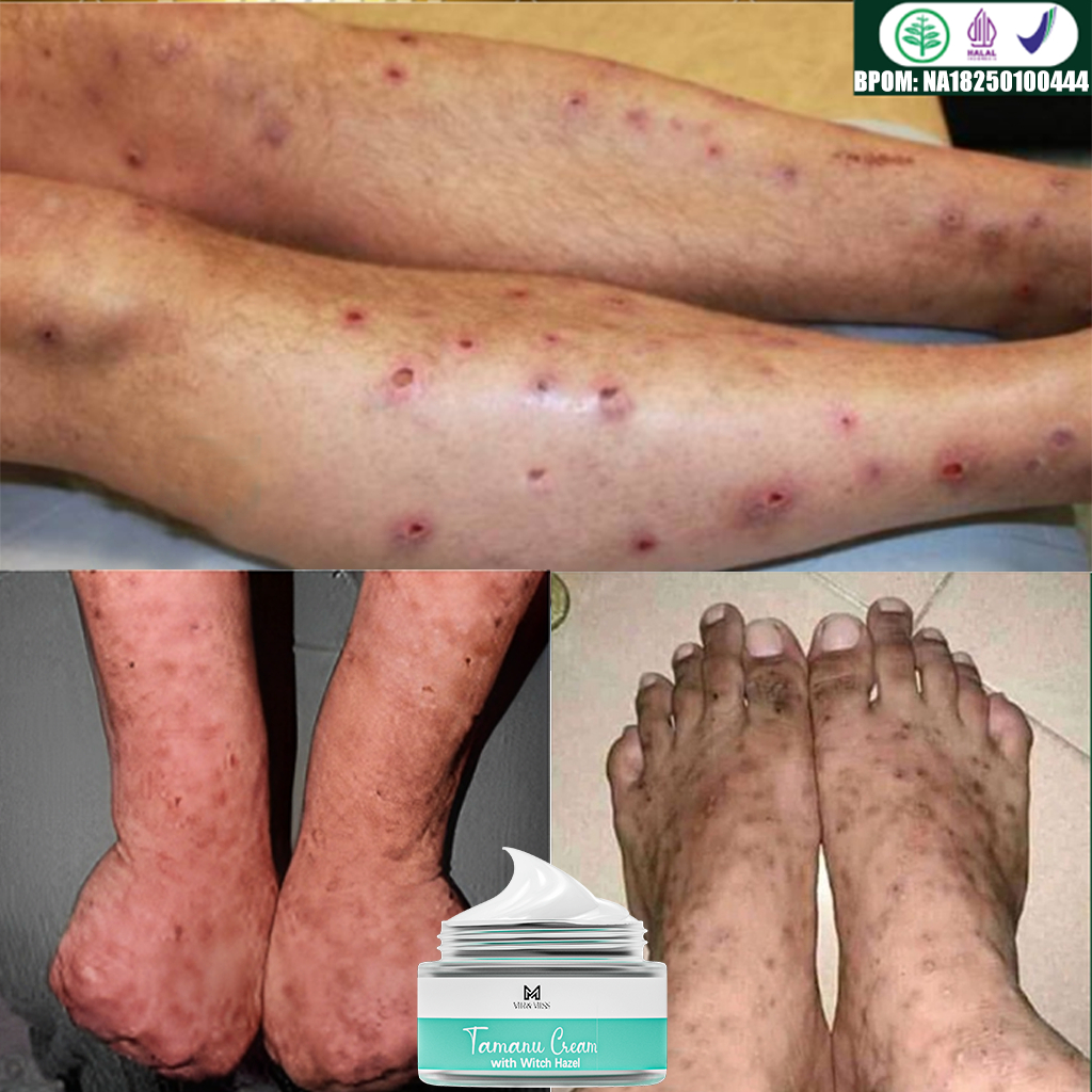 Salep penghilang bekas luka Obat penghilang bekas luka Salep penghilang bekas luka hitam Penghilang