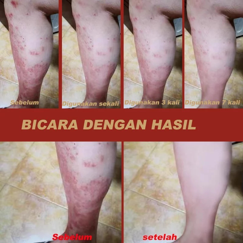 Reydokurniawan Salap Gatal Kulit Yang Ampuh Obat Gatal Selangkangan Obat Gatal Obat Eksim P Gatal