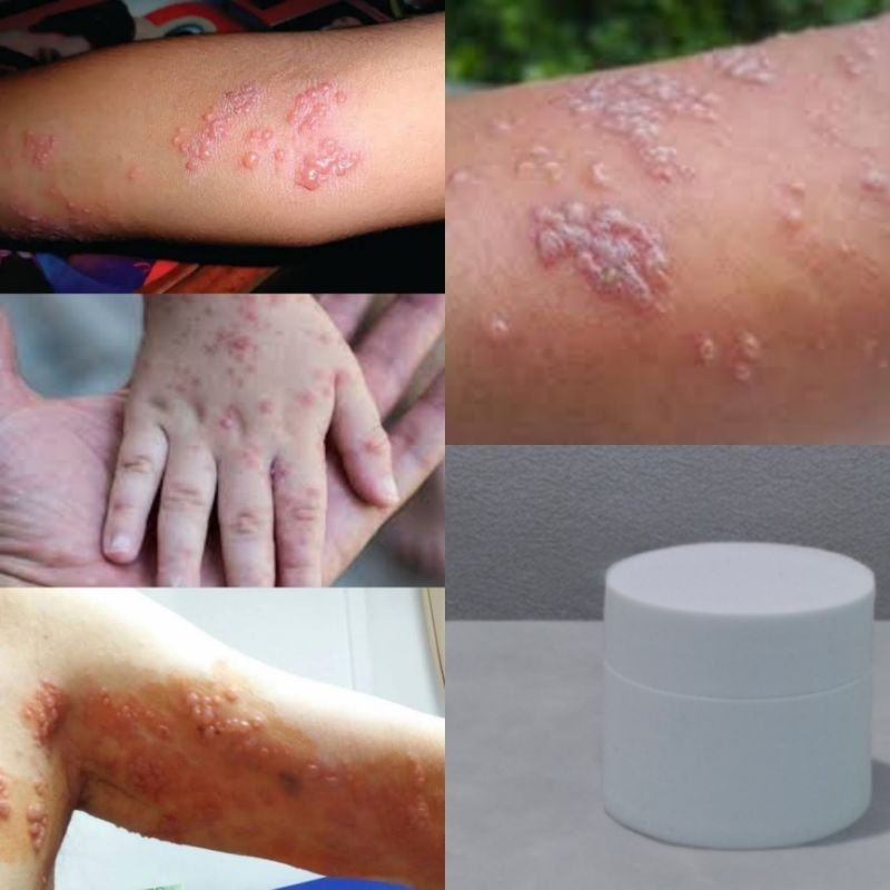 Salep Cacar Air / Cacar Api Terbaik untuk Anak dan Dewasa – Ampuh Redakan Gatal & Luka