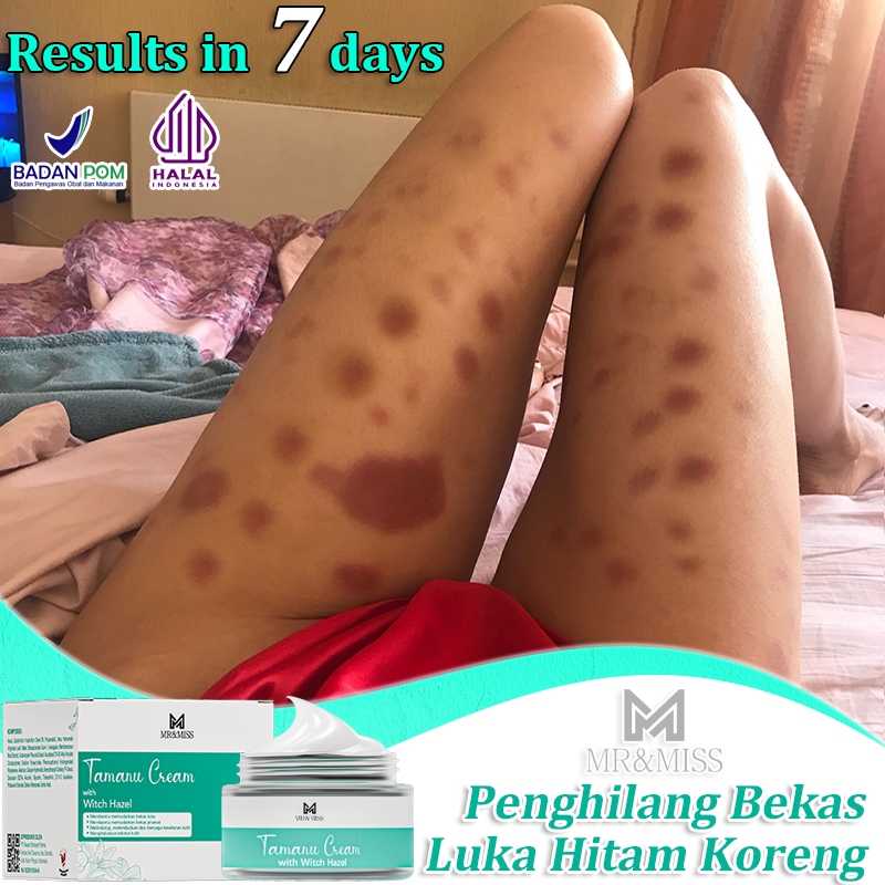 ISA Salep bekas luka cream penghilang bekas luka penghilang bekas luka salep penghilang bekas luka