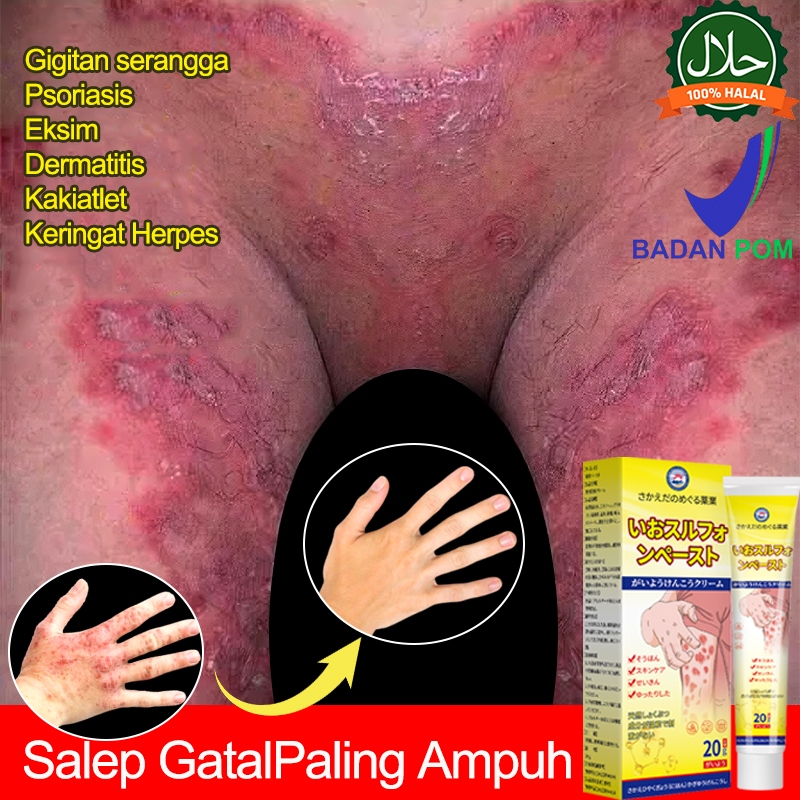 Obat kurap Obat gatal selangkangan Salep gatal china paling ampuh Salep gatal eksim paling ampuh 20g