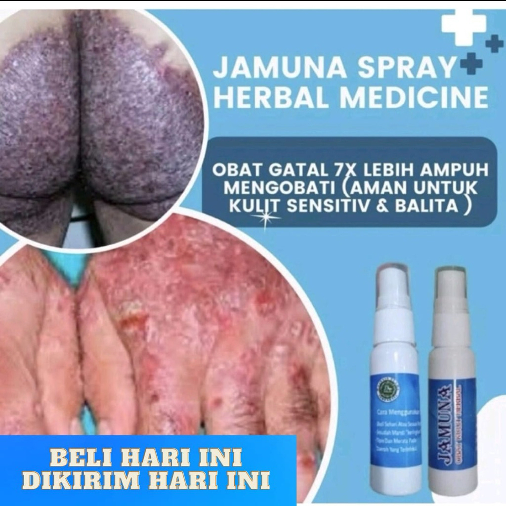 JAMUNA SPRAY - OBAT GATAL SELANGKANGAN | OBAT GATAL PALING AMPUH SELURUH BADAN | OBAT GATAL KULIT | 