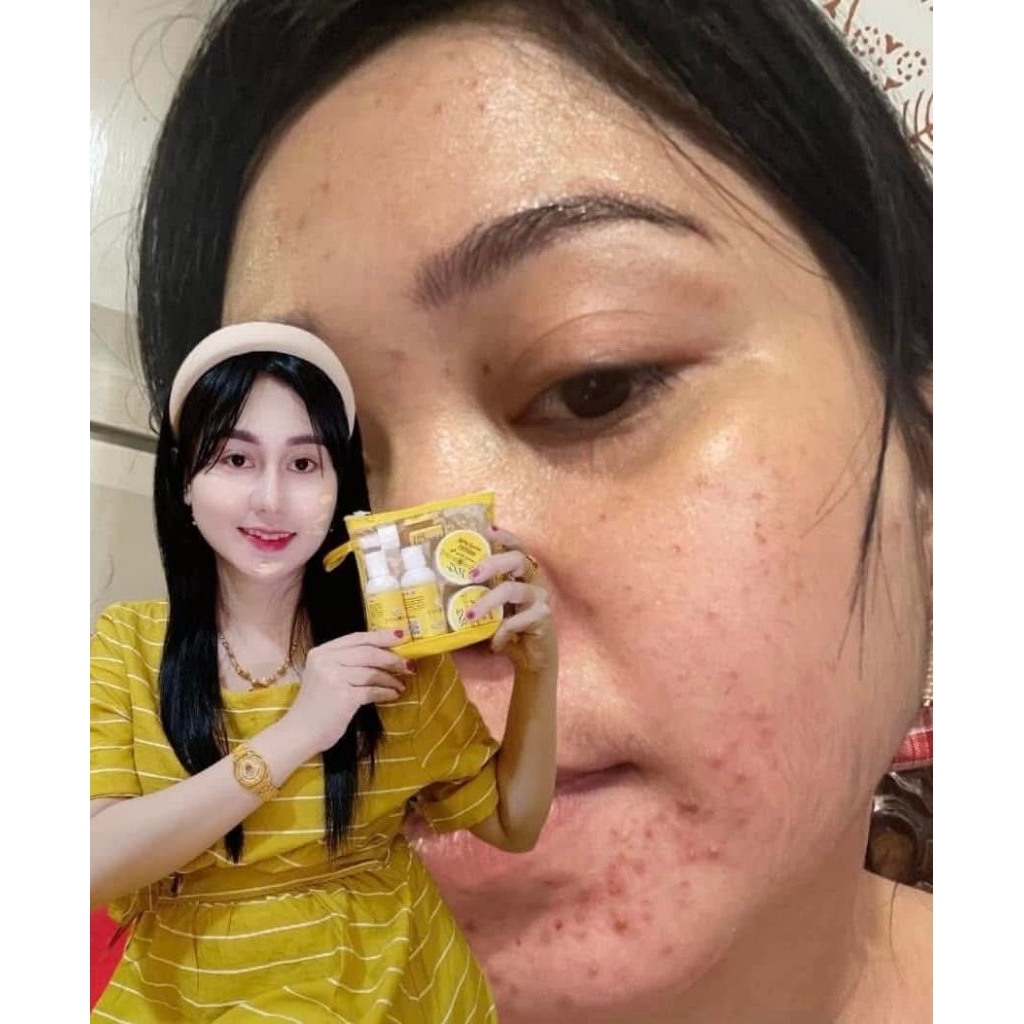 COD PAKET JERAWAT FLEK KUSAM DINDA SKINCARE BPOM RI VIRAL ORIGINAL