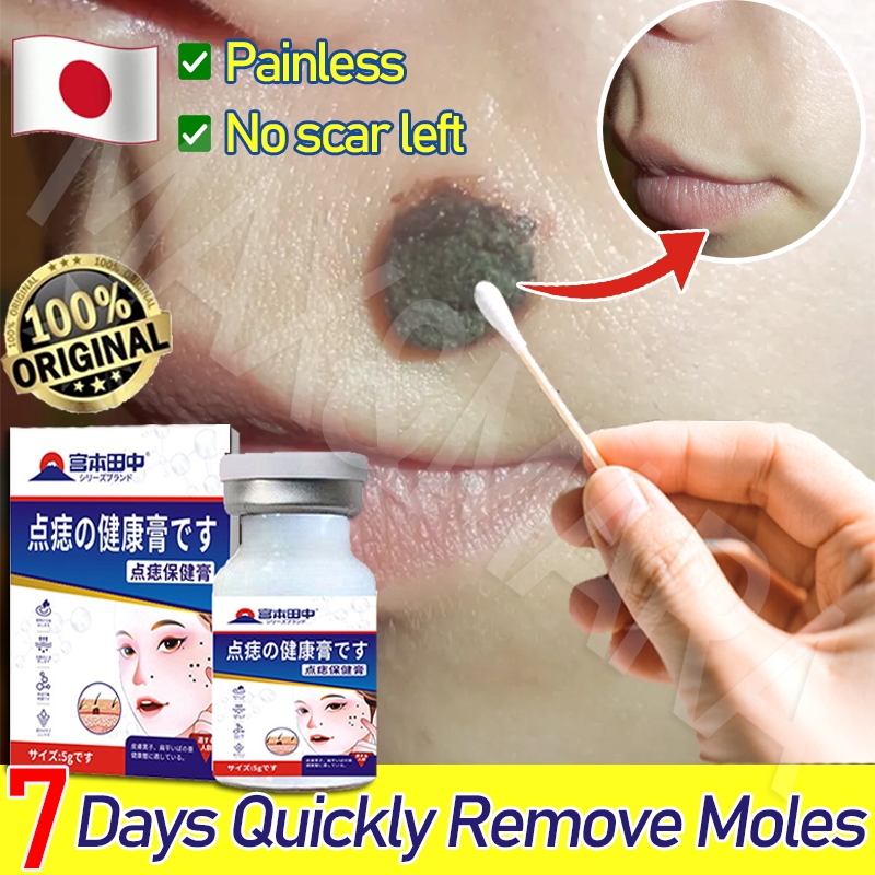 Obat penghilang tahi lalat Ampuh Skin tag remover Penghilang tahi lalat Penghilang tahi lalat di waj