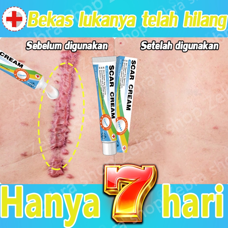 Krim penghilang bekas luka, krim bekas luka, penghilang bekas luka hitam, penghilang bekas luka, pen