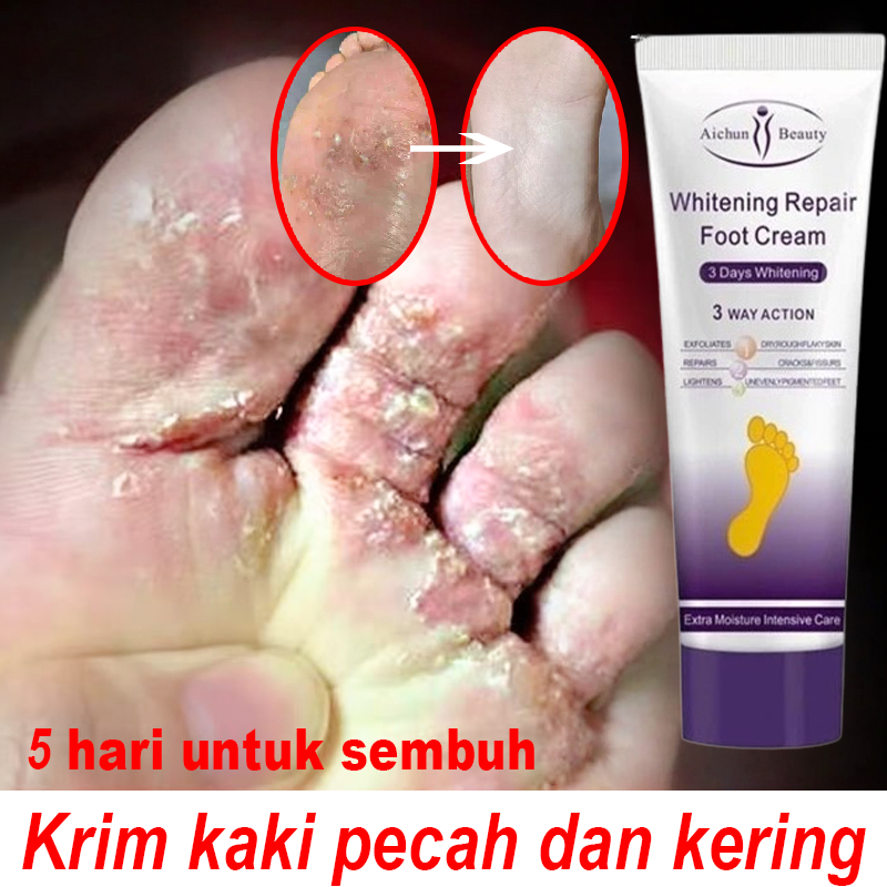 Salep kaki pecah2 paling ampuh Obat kaki pecah Pelembab kaki  kering dan pecah Perawatan kaki Penghi