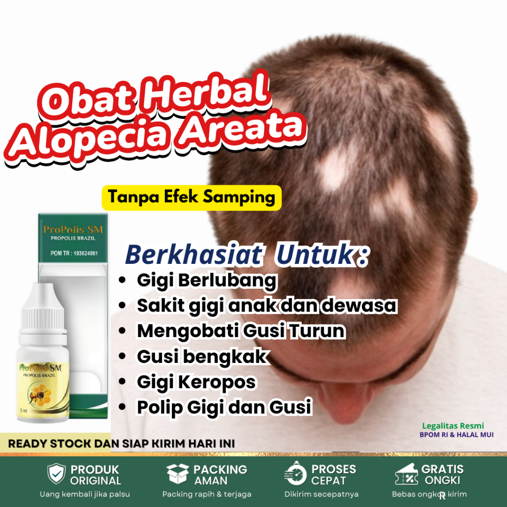 Obat Alopecia Areata, Obat Penumbuh Rambut Rontok, Obat Botak Pitak, Obat Autoimun, Obat Kebotakan R