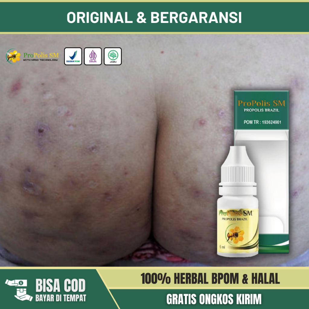 Obat Pantat Gatal, Obat Pantat Burik, Obat Pantat Bruntusan, Obat Jerawat Di Pantat, Obat Koreng Di 