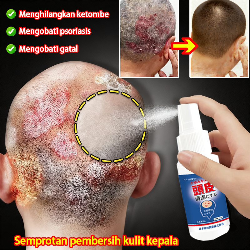 Obat Ketombe Psoriasis Kulit Kepala Berkerak Kulit Kepala Gatal Ketombe Berkerak Ketombe Kering Psor