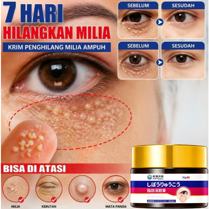 Krim Penghilang Milia Paling Ampuh Eye Cream Milia Remover Obat Milia Di Bawah Mata Krim Milia Mengh