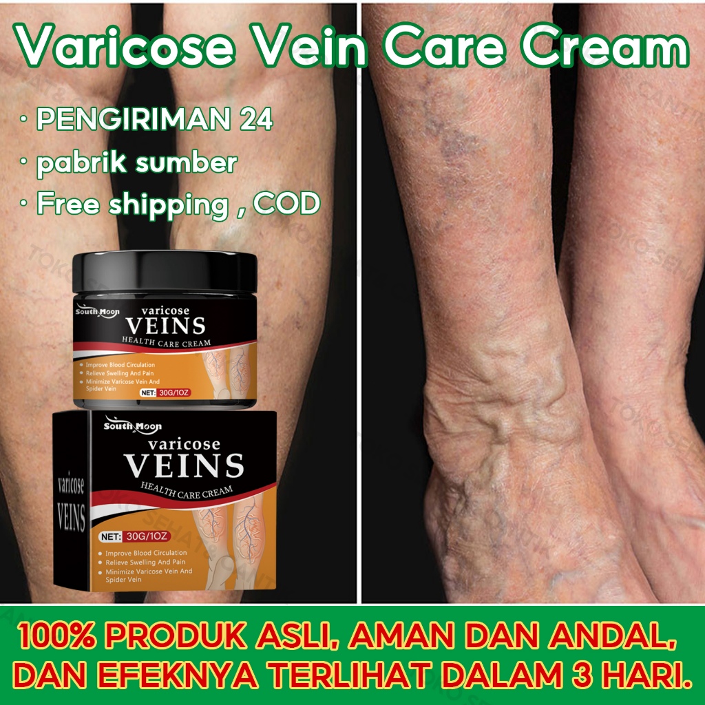 South Moon Varicose Veins Cream 30g Krim Varises Meredakan Nyeri Dan Bengkak, Memperbaiki Varises Da