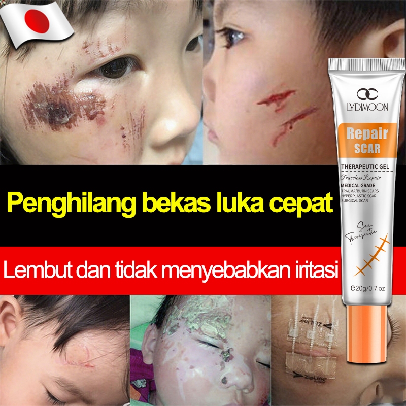 Penghilang bekas luka ampuh untuk anak, penghilang bekas gigitan serangga, gel bekas luka 20g untuk 