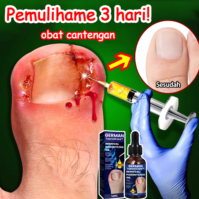 Obat Cantengan Salep Cantengan Jempol Kaki Obat Kuku Rusak Paku Obat Jamur Kuku Obat Kuku Jamur Dan 