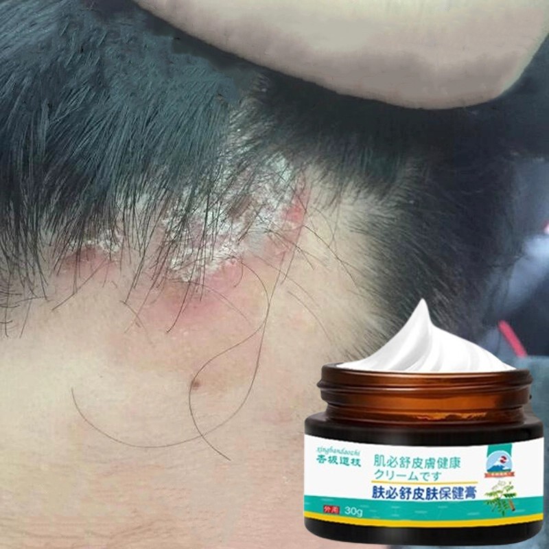 Obat ketombe parah Seborrheic dermatitis cream krim kepala gatal Psoriasis Ketombe Parah Scalp Itchi
