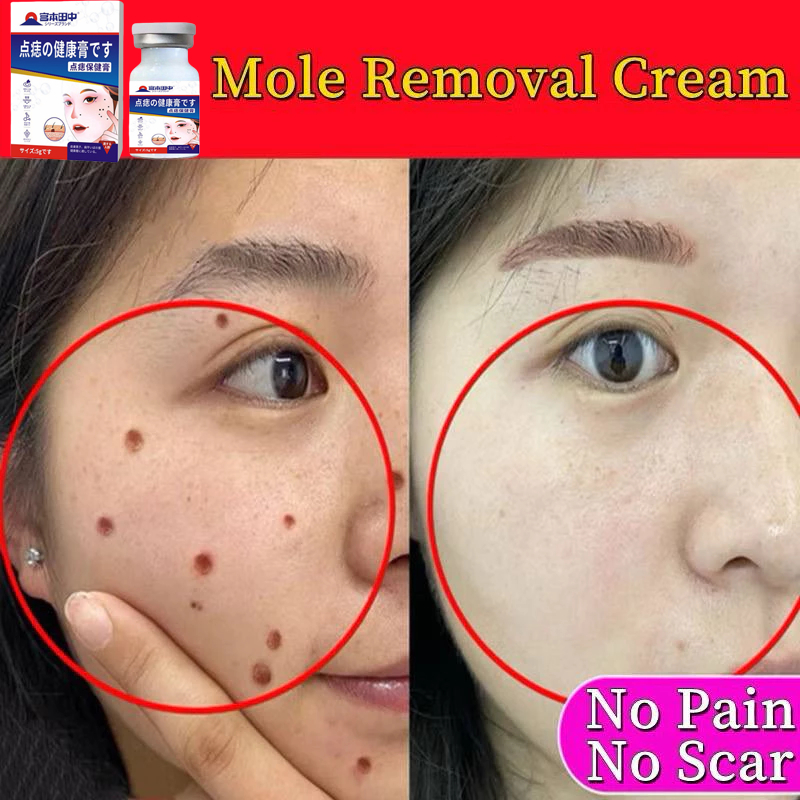 penghilang tahi lalat penghilang kutil dan tahi lalat Obat Penghilang Tahi Lalat penghilang tahi lal