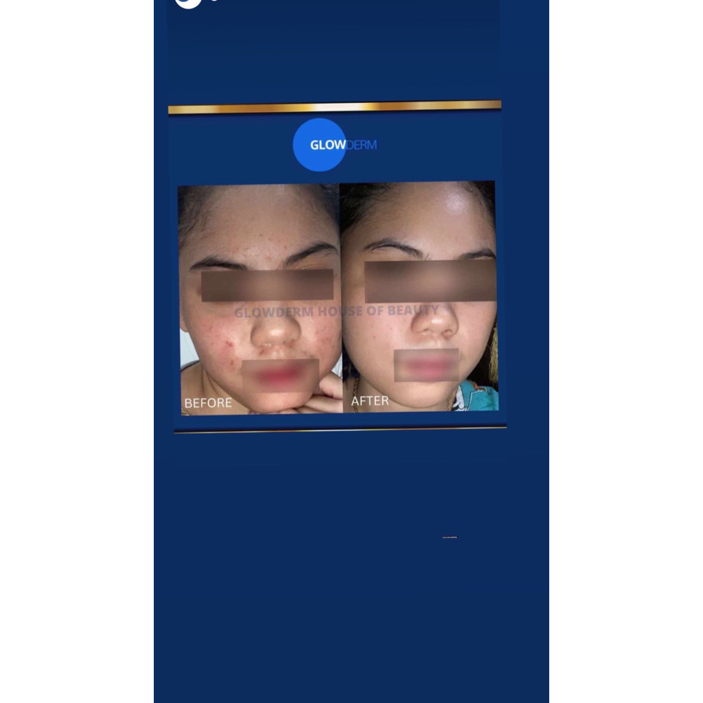 Glowderm Acne Series