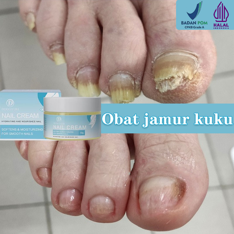 【BPOM】DODOYURI Obat kuku jamur dan rusak Perawatan kuku Obat jamur kuku 30g Jamur kuku Obat kuku Jam