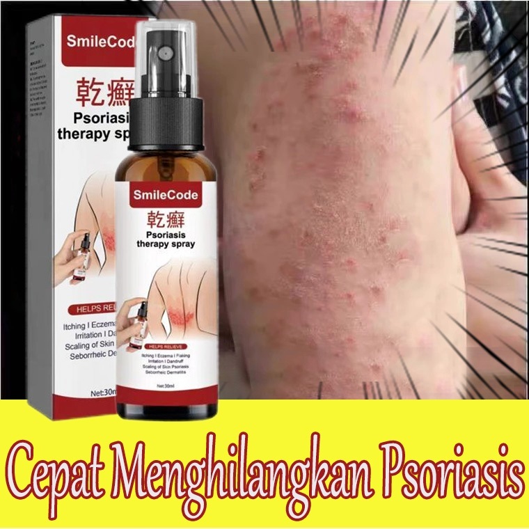 Obat gatal kulit Obat gatal gatal seluruh badan Cream gatal Obat gatal eksim Krim penghilang gatal -