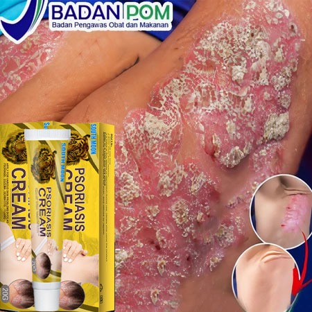 Obat Kurap Salep Antipruritik Paling Ampuh untuk Tinea Cruris Salep Penghilang Gatal Paling Efektif 