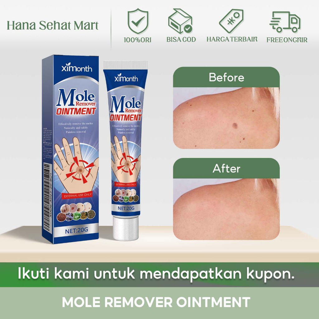 Ximonth Mole Remover Dintment 20g Krim Penghilang Kutil Tanpa Rasa Sakit, Penghilang Tahi Lalat Yang