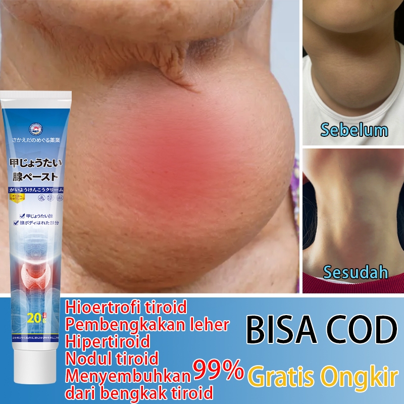 Jepang krim Tiroid Obat benjolan di leher Obat Gondok 20g Obat Kelenjar Tiroid Gondok Beracun Hipert