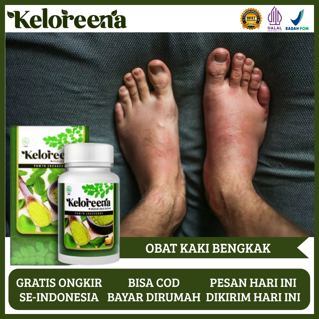 Obat Kaki Bengkak, Obat Kaki Bengkak Keseleo, Obat Kaki Bengkak Asam Urat, Obat Kaki Bengkak Diabete