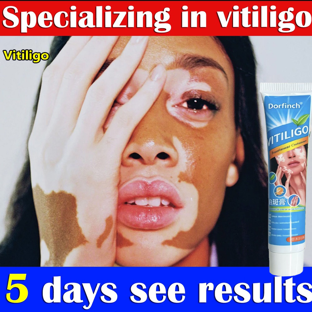 Pengobatan Vitiligo krim vitiligo ampuh /protopic Vitiligo alep vitiligo, panu, biang keringat, Krim