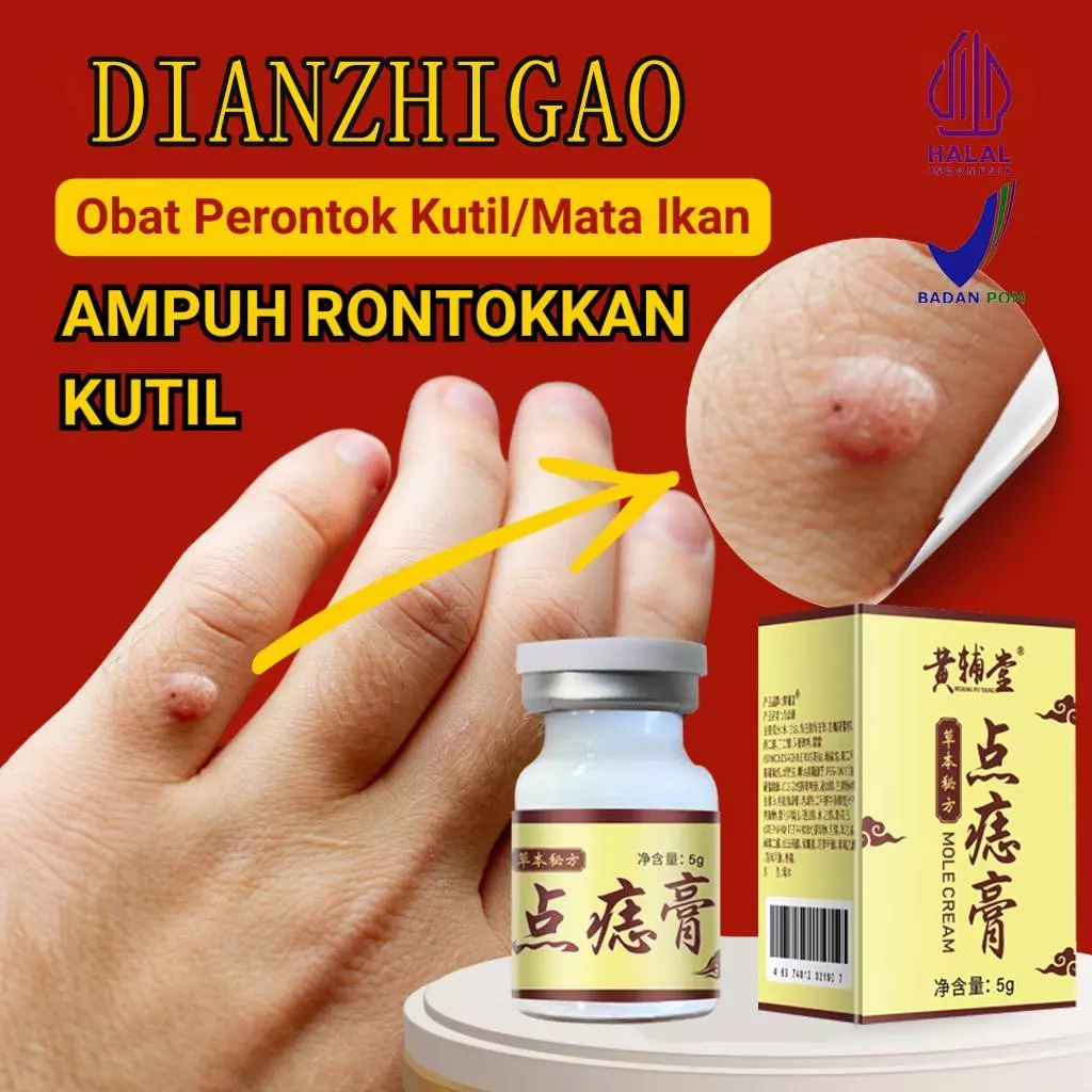 Krim penghilang kutil Krim penghilang tahi lalat di wajah Obat untuk mengatasi kutil dan tahi lalat 