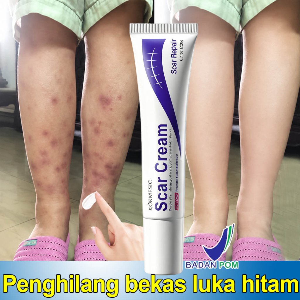 Salep penghilang bekas luka Salep keloid Salep bekas luka Penghilang bekas luka di kaki Penghilang b