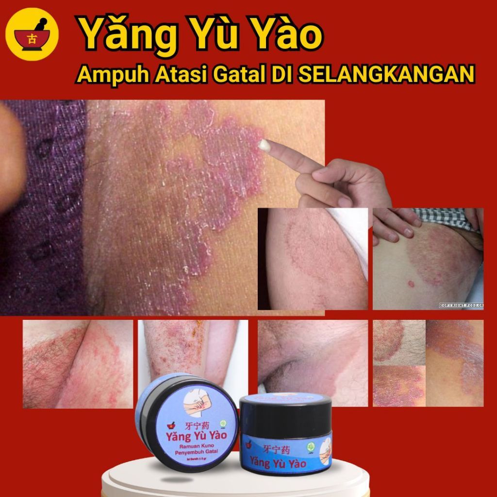 Obat Salap Gatal Eksim di Selangkangan China Yang Yu Yao Sangat Ampuh Tanpa Bekas