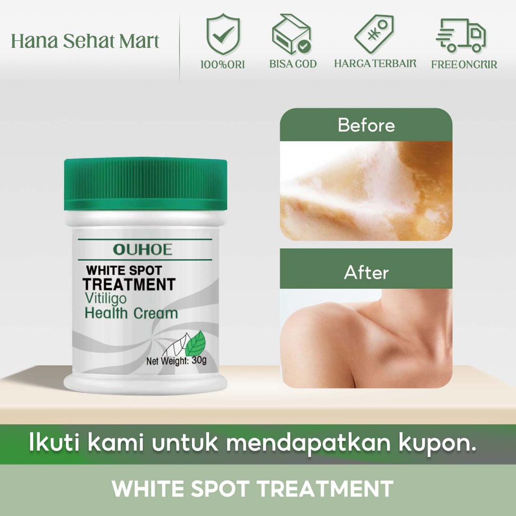OUHOE vitiligo cream original 30g Penghilang Bintik Putih, Tinea Manuum, Krim Perawatan Tinea Pedis,