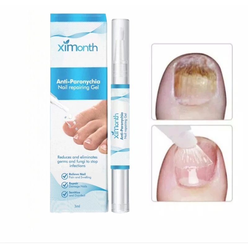 Serum kuku jamur dan rusak Anti-paronychia gel pedikal Obat jamur kuku Obat cantengan jempol kaki ku