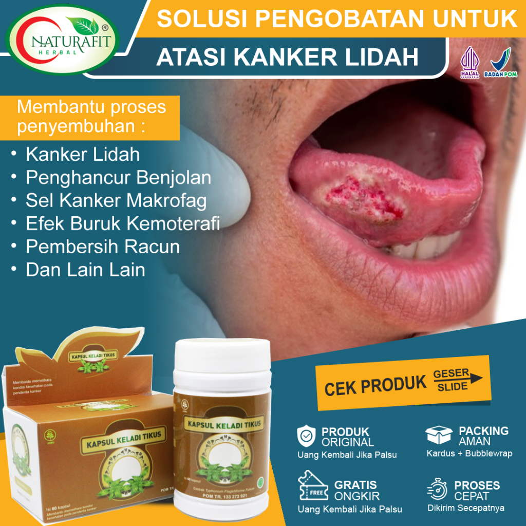 Obat Kanker Lidah Paling Ampuh, Tumor Lidah, Kandidiasis, Kangker Kelenjar Air Ludah, Benjolan Kanke