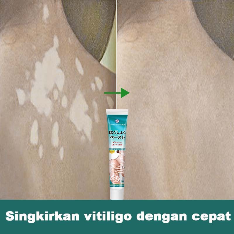Salep vitiligo ori 100% Obat vitiligo Salep vitiligo Salep bercak putih di wajah anak Vitiligo salep
