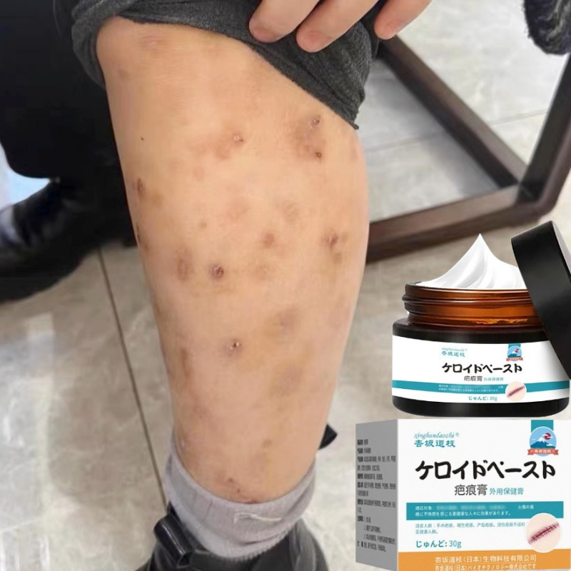 Penghilang bekas luka Penghilang bekas koreng hitam di kaki Penghilang Bekas cacar Bekas lama Bekas 