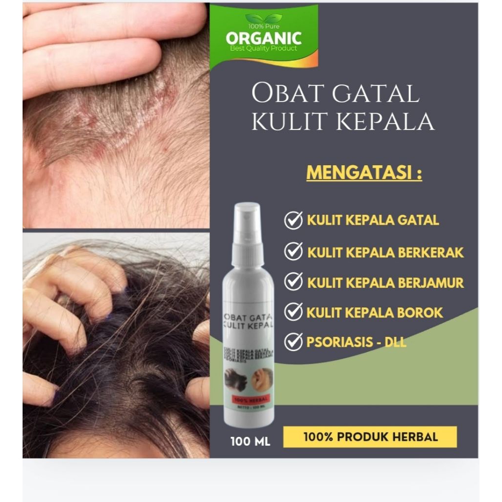 obat gatal kepala ketombe penghilang gatal di kulit kepala