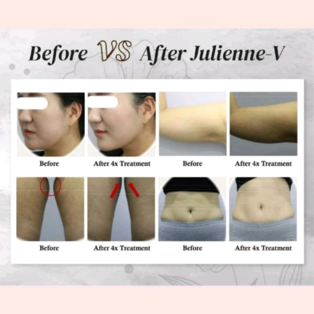 JULIENNE SLIMMING/Meso Lipo Alat slimming meso lipo tanpa rasa sakit pembakar lemak