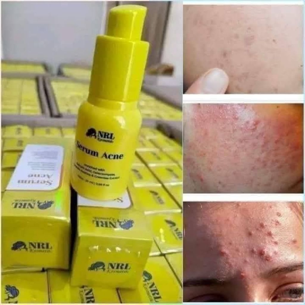 Serum acne NRL
