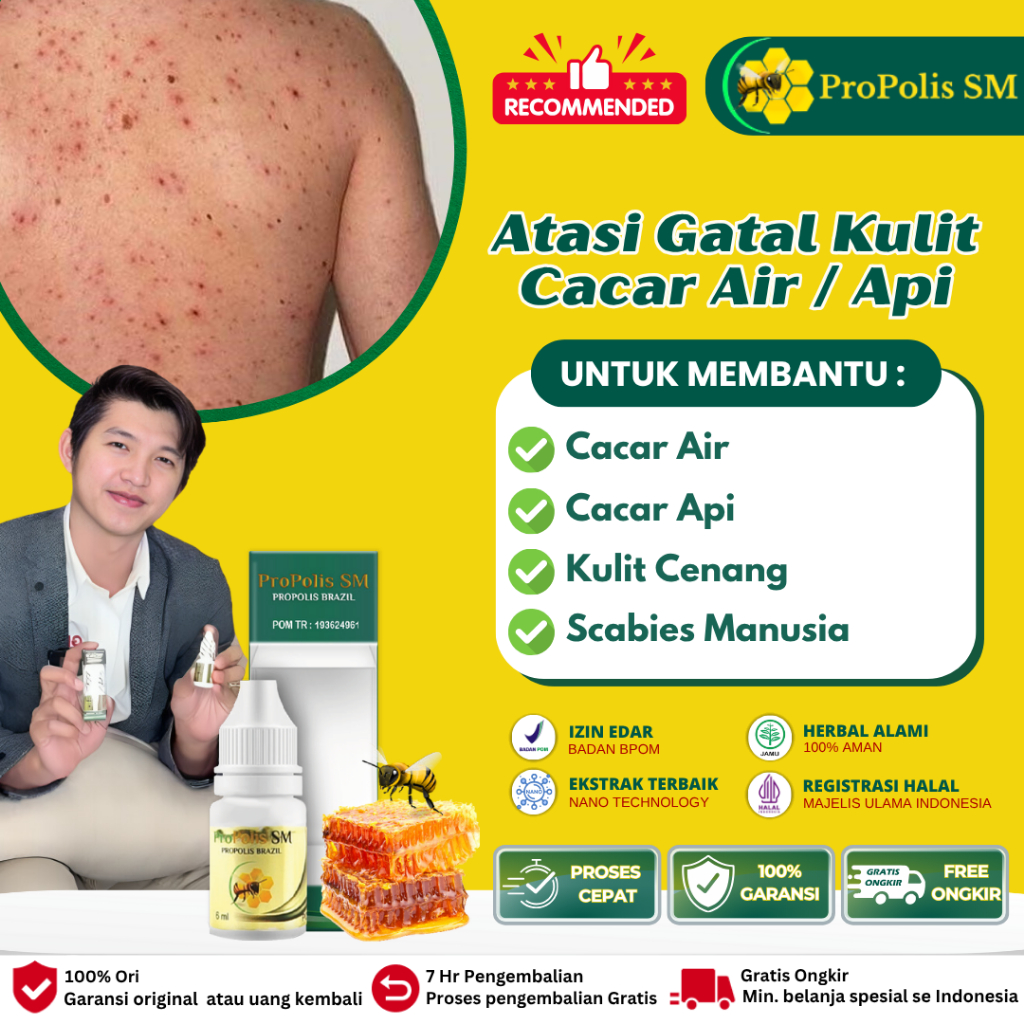 Obat Cacar Air - Salep Cacar Air - Obat Kulit Cacar - Obat Cacar Api - Salep Cacar Api - Obat Cacar 