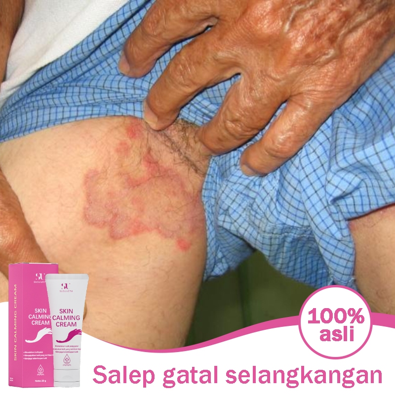 Salep gatal selangkangan 0bat gatal gatal kulit ampuh Salep eksim kering dan gatal 20g Salap gatal k