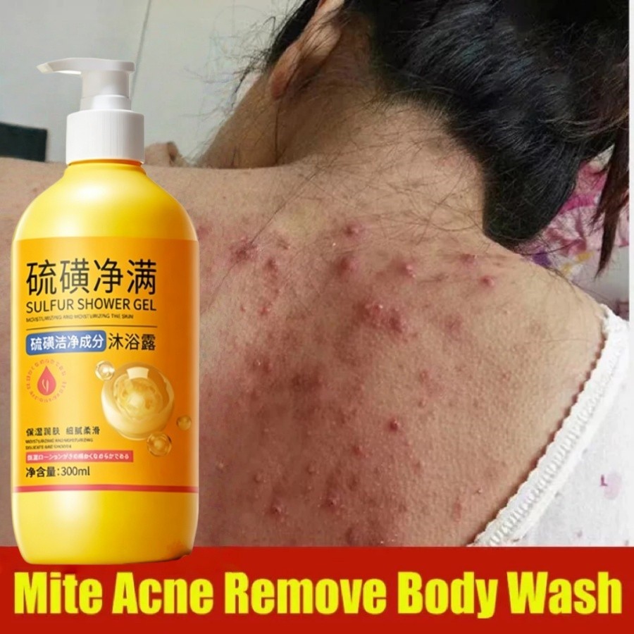 Eczema BodyWash 500ml Sabun Gatal Sulfur Cair Sabun Mandi Belerang Sulfur Cair Sulfur BodyWash Untuk