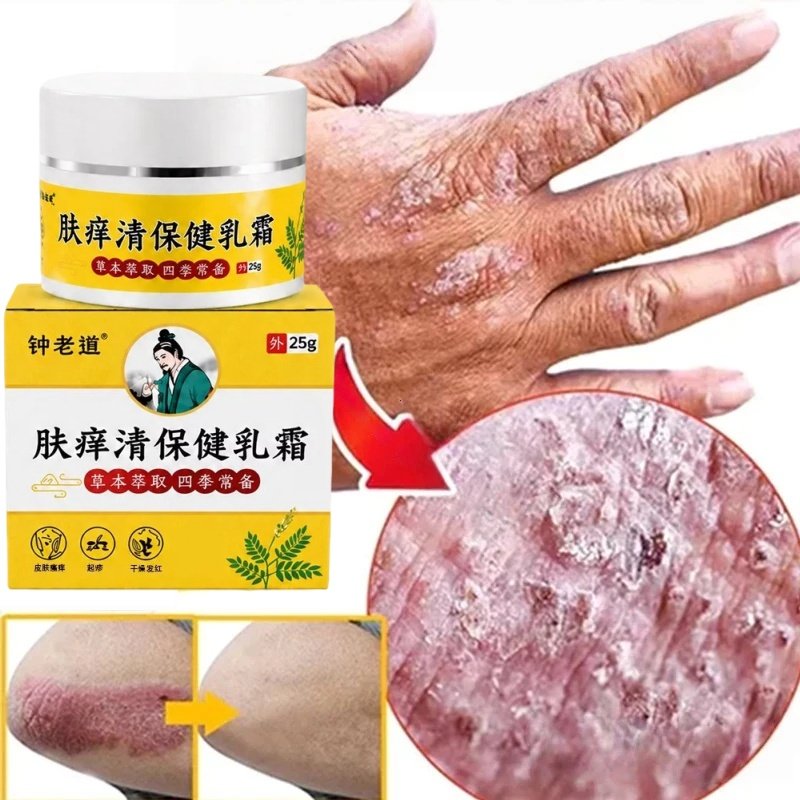 salep gatal paling ampuh Salep Eksim Kering dan Gatal Salep Bayi Untuk Kulit Iritasi obat eksim psor
