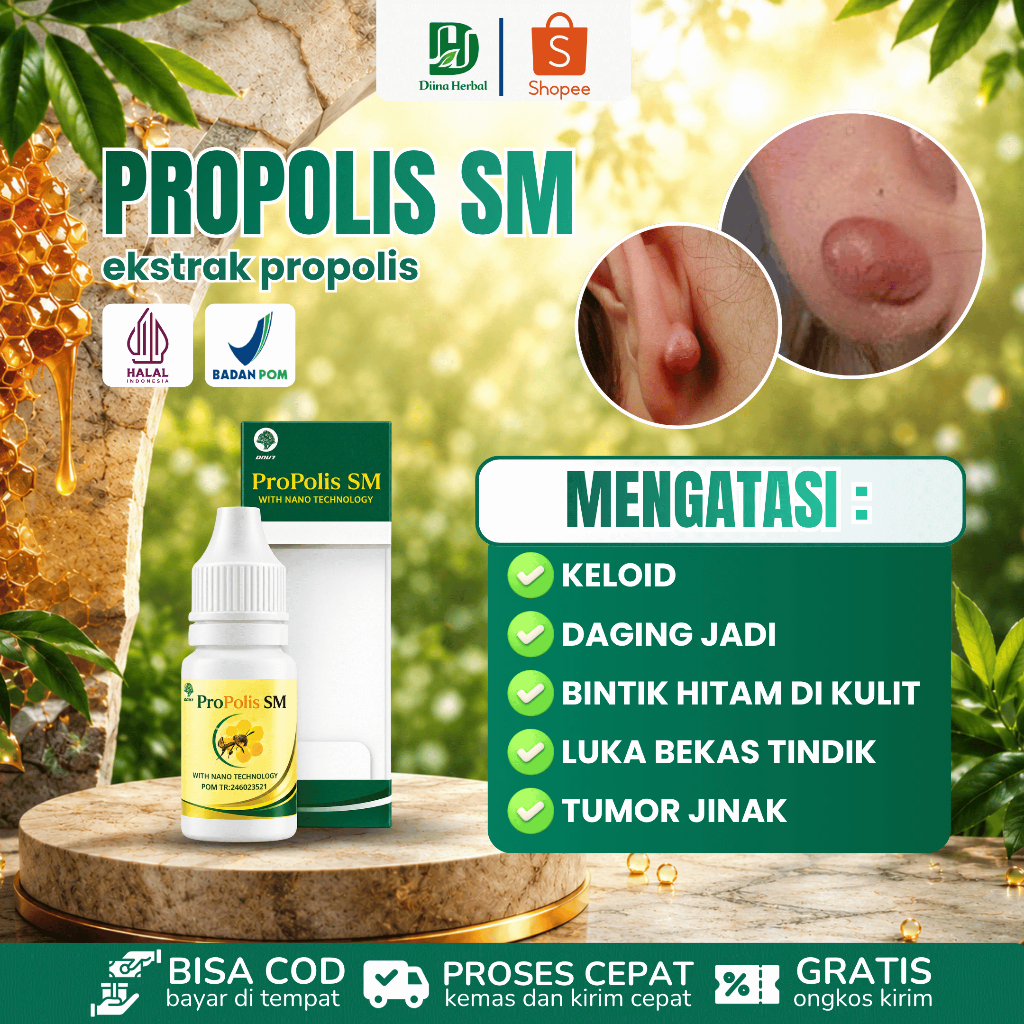 Obat Keloid, Obat Penghilang Keloid Daging Tumbuh, Obat Keloid di Telinga, Obat Penghilang Bekas Tin