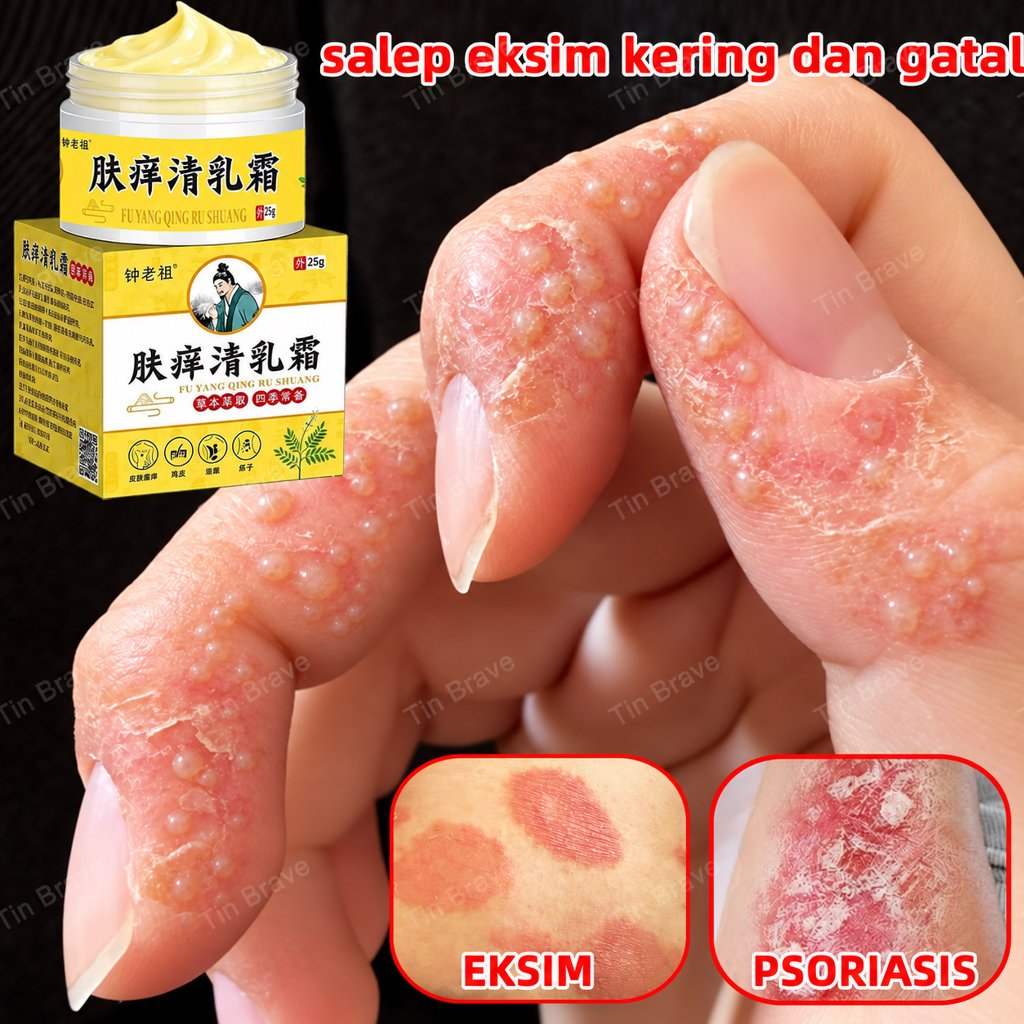 salep eksim kering dan gatal salep gatal china obat gatal selangkangan salep selangkangan eksim dan 