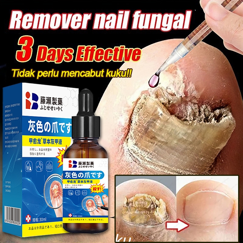 Obat Jamur Kuku Anti Jamur Perawatan Kuku Obat Kuku Jamur Dan Rusak Original Serum Kuku Jamur Dan Ru