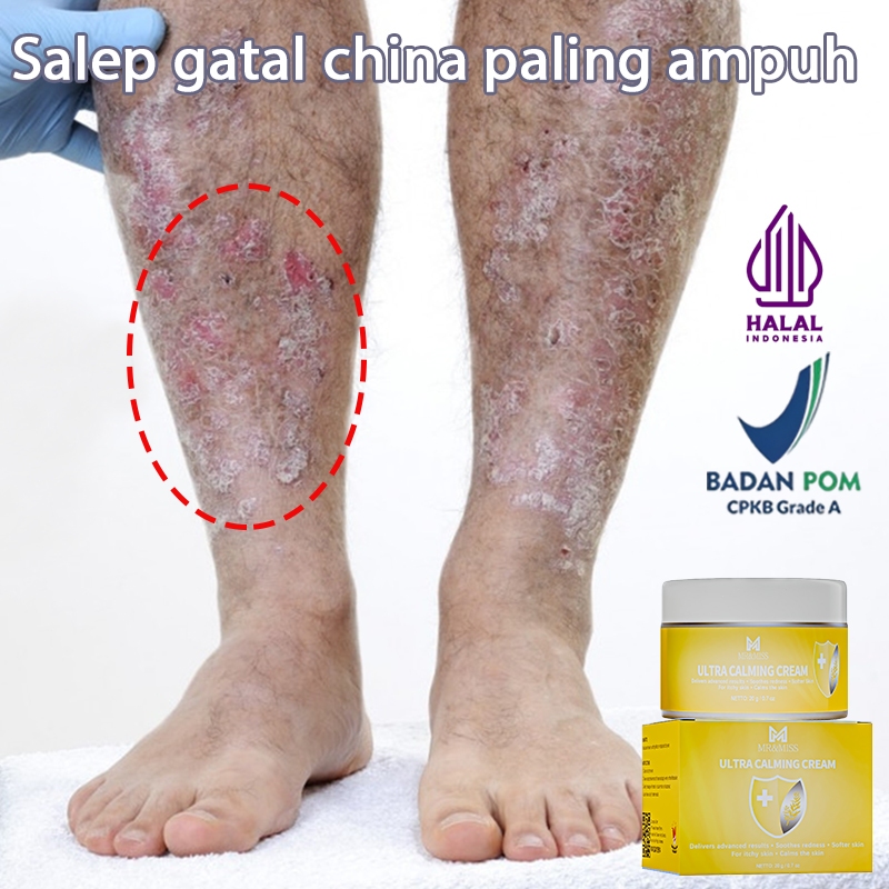 Salap gatal kulit yang ampuh salep eksim kering dan gatal salep jamur kulit paling ampuh 20g obat ga